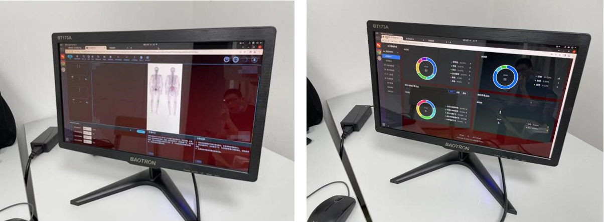 智能全身骨顯像系統(tǒng)成功部署達州市中心醫(yī)院