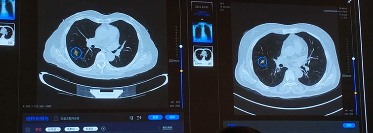 “華西醫(yī)院&依圖醫(yī)療”人工智能成果發(fā)布舉行